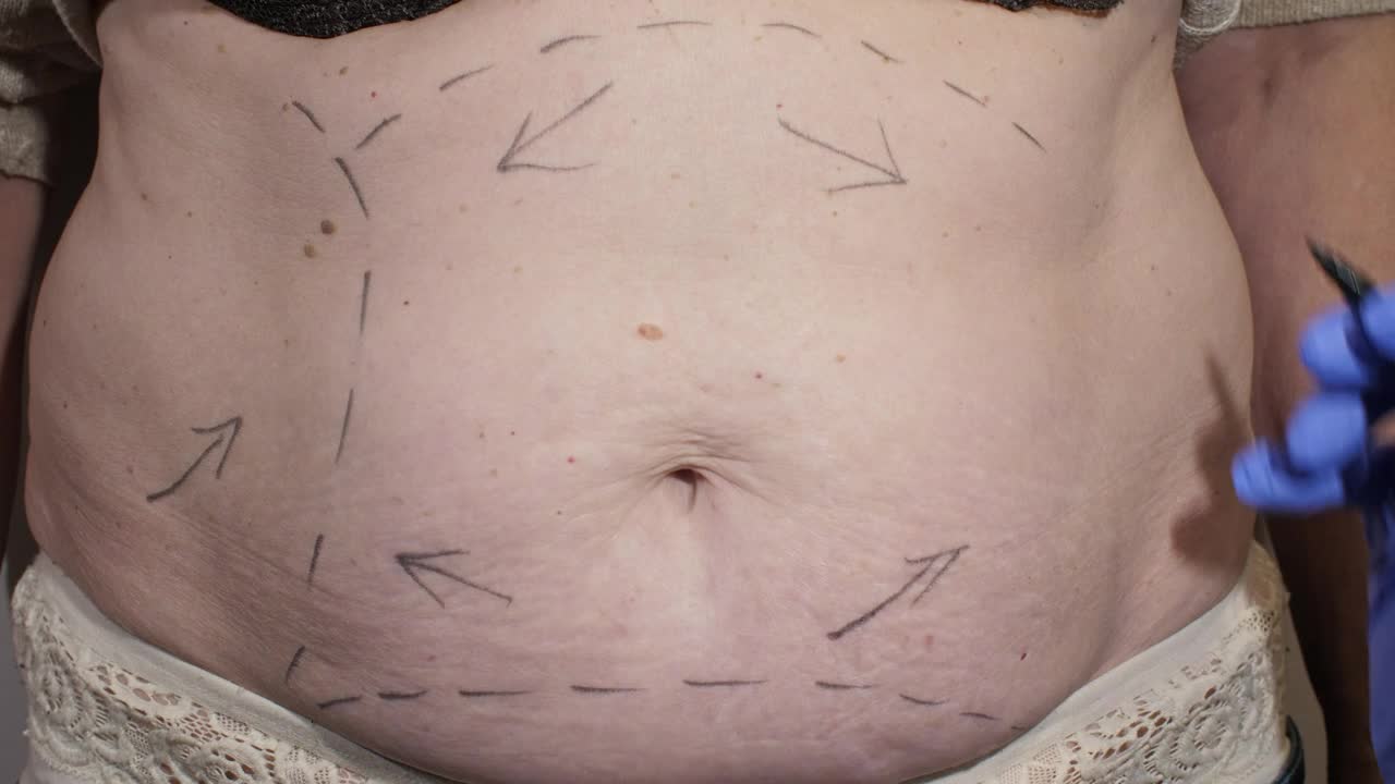 Stock Video Marking Abdomen Before Liposuction Surger Animated Wallpaper - Free Download