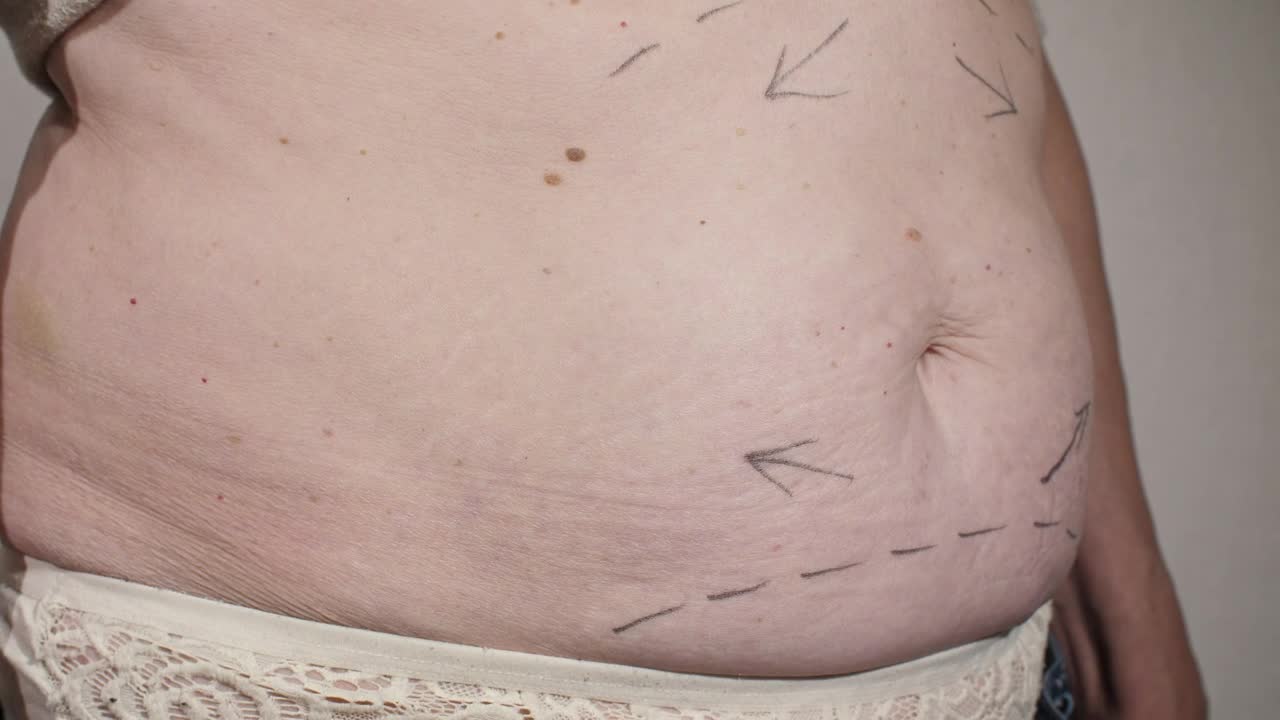 Stock Video Marking A Womans Abdomen Before Liposuctio Animated Wallpaper - Free Download