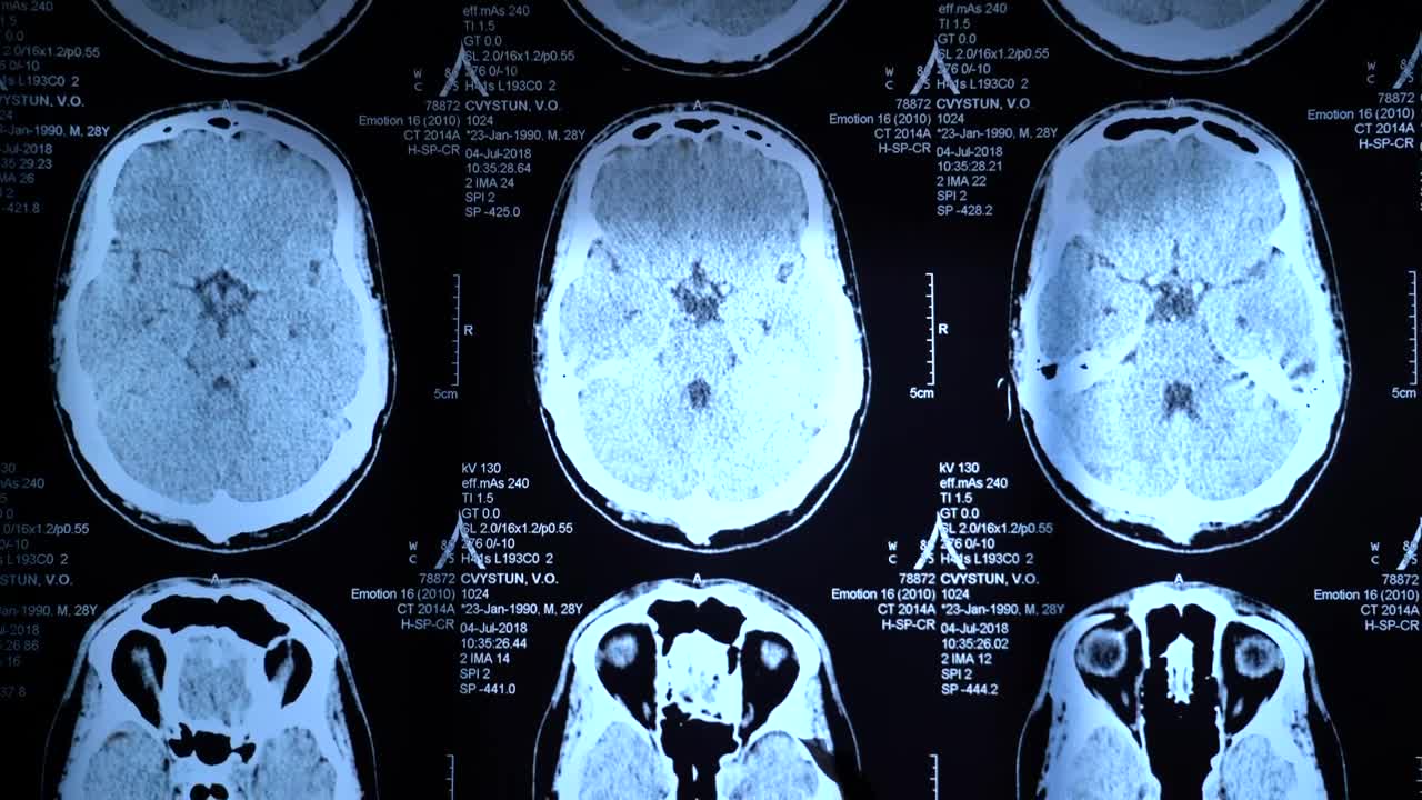 Free Video Stock Skull X Rays View Live Wallpaper - Free Download