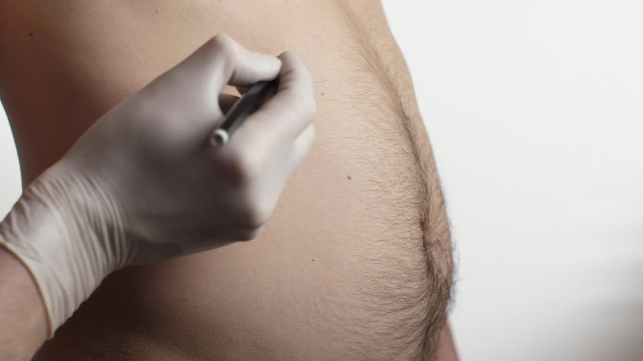 Stock Video Marking A Mans Abdomen Before Liposuction Surger Animated Wallpaper - Free Download